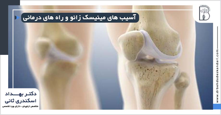 درمان پارگی مینیسک زانو در شیراز