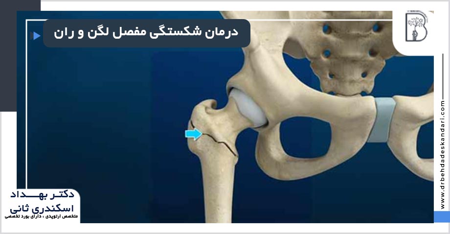 درمان شکستگی مفصل لگن و ران در شیراز