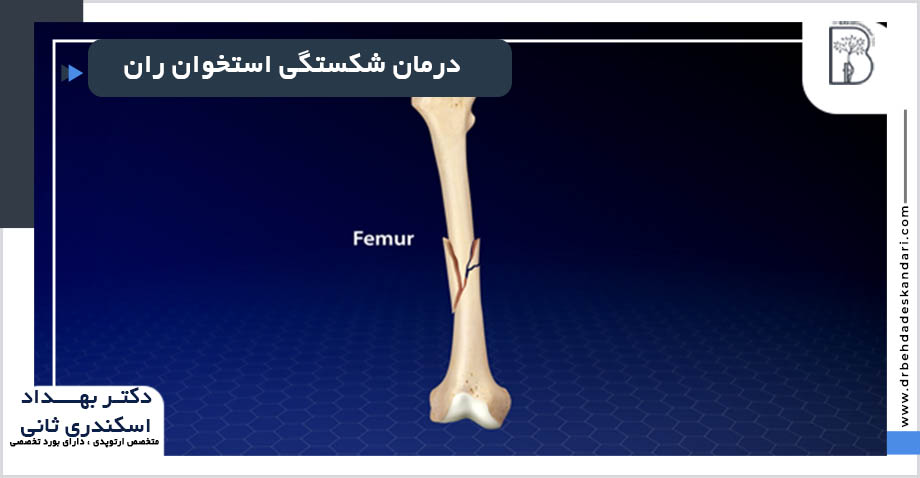 درمان شکستگی استخوان ران در شیراز
