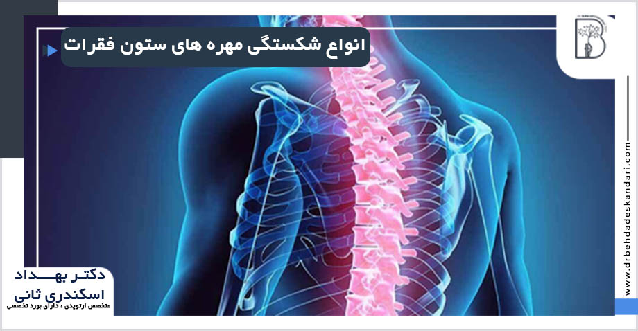 درمان شکستگی ستون فقرات در شیراز