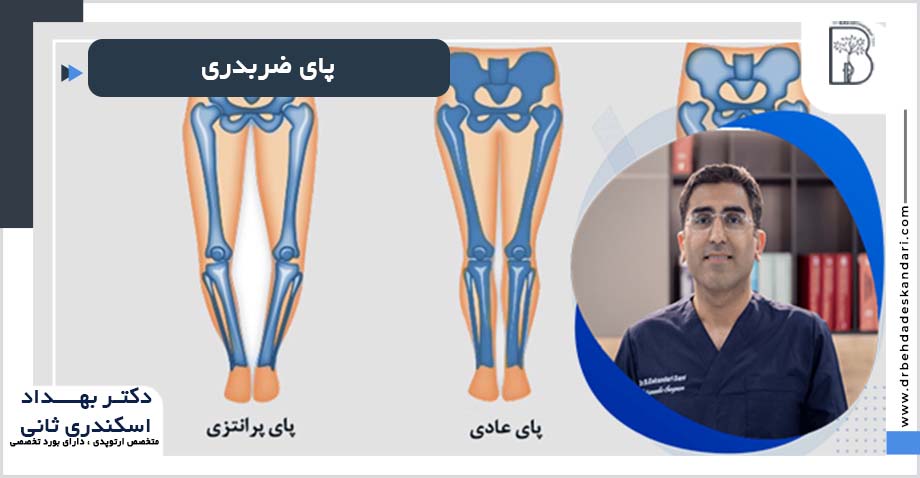 درمان پای ضربدری در شیراز