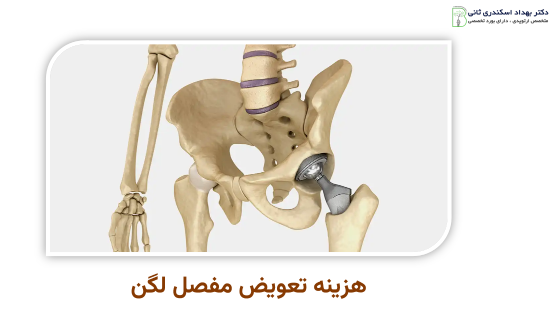 هزینه تعویض مفصل لگن